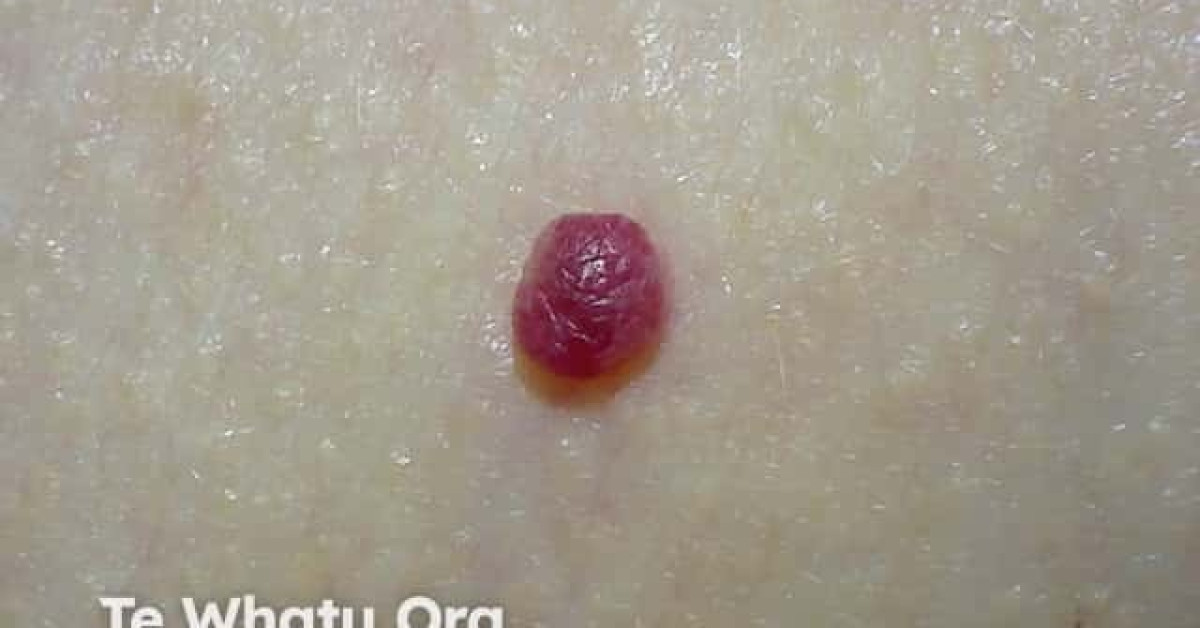 Cherry Angioma Image