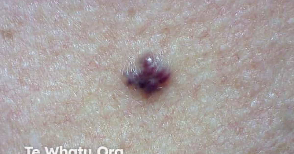 DermNet® - Cherry angioma image