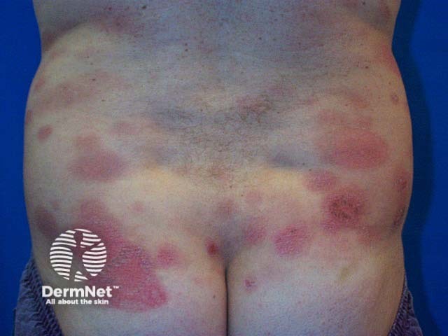 Urticarial vasculitis