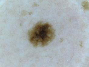 Naevus, skin type 2, dermoscopy 1