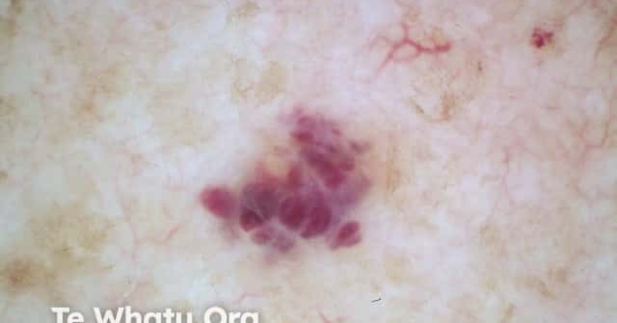 Cherry angioma dermoscopy image