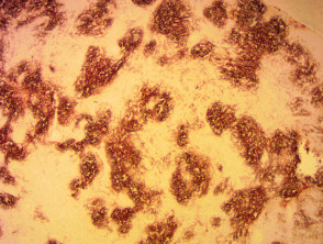 Immunohistochemistry of angioimmunoblastic T-cell lymphoma