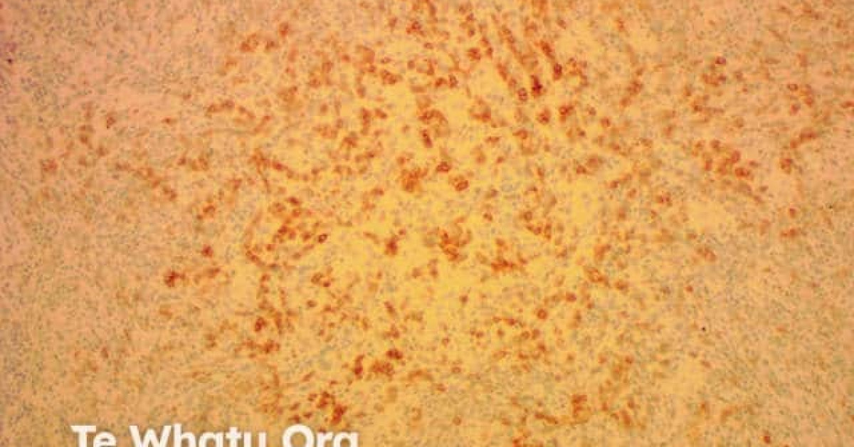 DermNet® - Immunohistochemistry of angioimmunoblastic T-cell lymphoma image