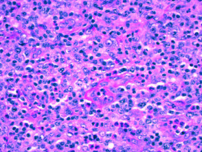 Histology of angioimmunoblastic T-cell lymphoma