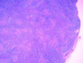 Histology of angioimmunoblastic T-cell lymphoma