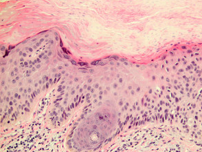 Pathology of actinic keratosis
