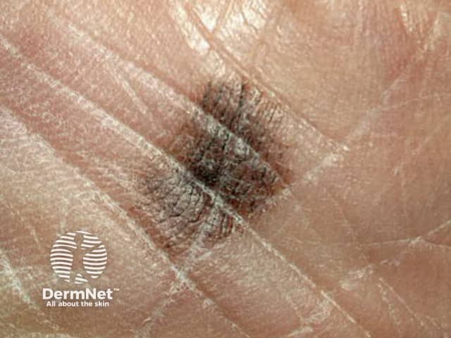 Irregular margin and pigmentation of an acral lentiginous melanoma