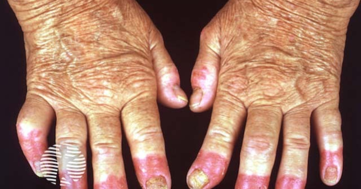 Acrodermatitis Continua Of Hallopeau Image