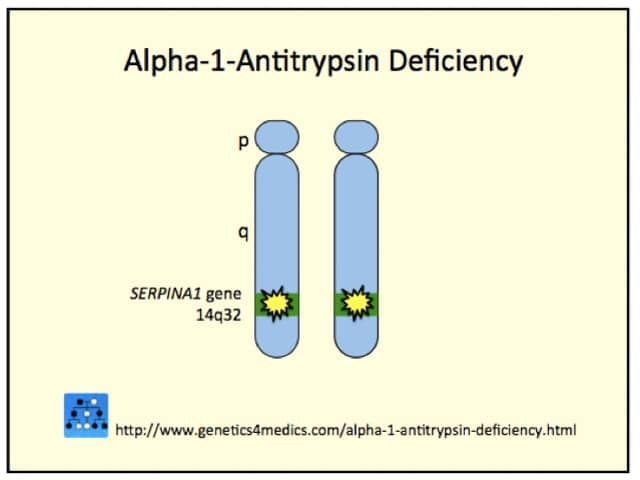 Genetics of alpha-1-antitrypsin deficiency*