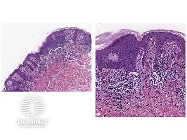 Annular lichenoid dermatitis histopathogy