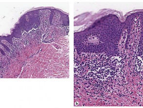 Annular lichenoid dermatitis histopathogy