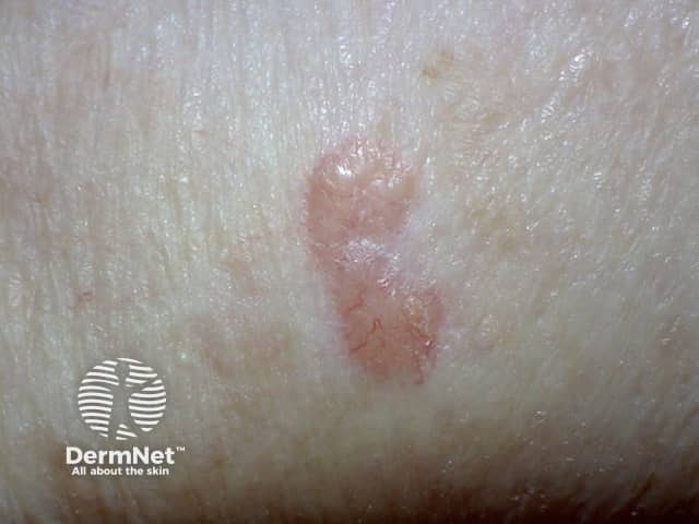 Basal cell carcinoma affecting the arms and legs 12 macro
