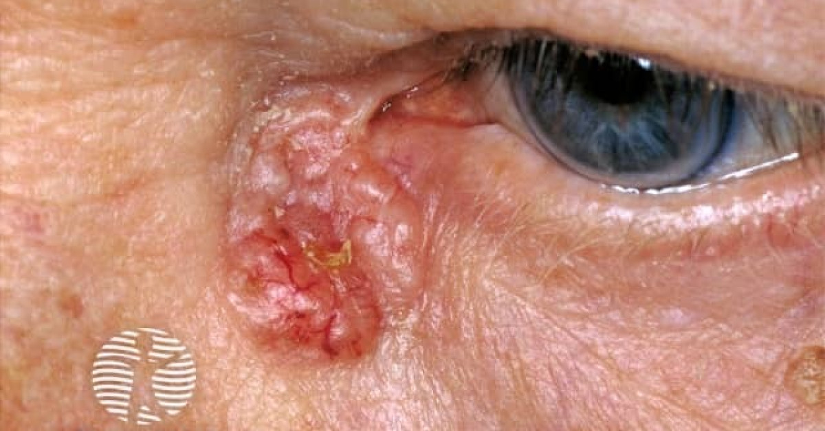 Basal cell carcinoma of medial canthus image