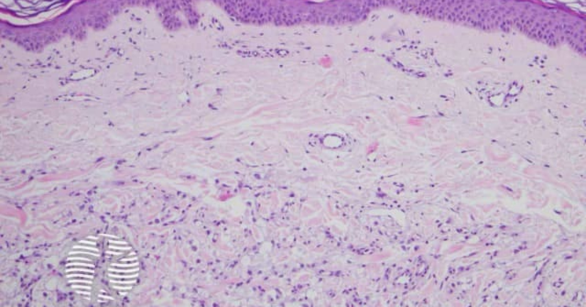 DermNet® - CCMN figure 1 image