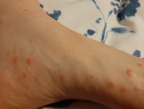 Rash on feet associated with COVID-19