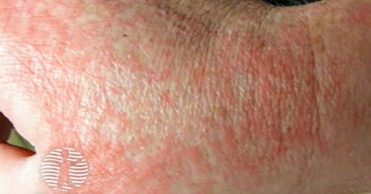 DermNet® - Rash associated with COVID-19 image