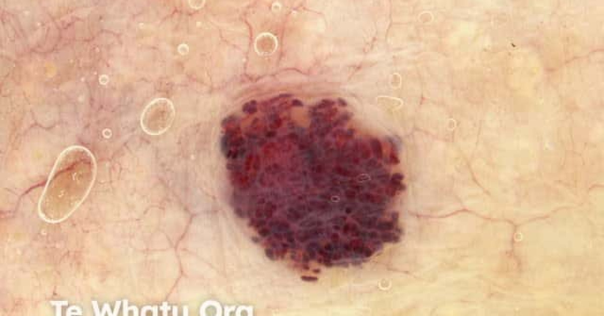 Cherry angioma dermoscopy image