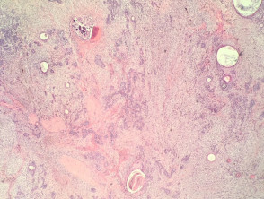 Combined cellular blue naevus and trichoepithelioma