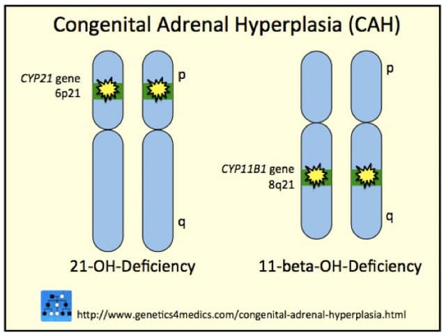 Congenital adrenal hyperplasia (CAH) genetics*