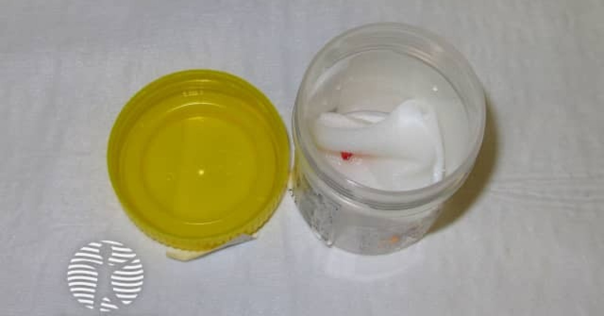 Punch biopsy transported on salinesoaked gauze image