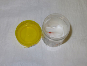 Punch biopsy transported on saline-soaked gauze