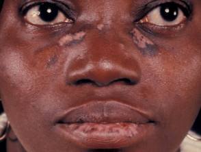 Hypopigmentation and hyperpigmentation in black skin
