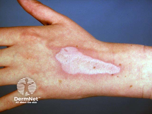 Chemical burn scar with leukoderma