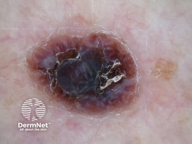 Dermoscopy of nodular melanoma
