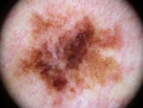 Lentigo maligna melanoma