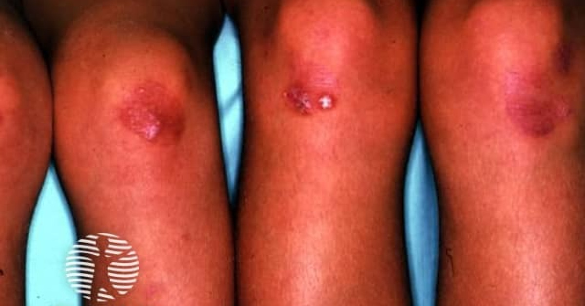 Ehlers-Danlos syndrome image