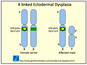 Ectodermal dysplasia