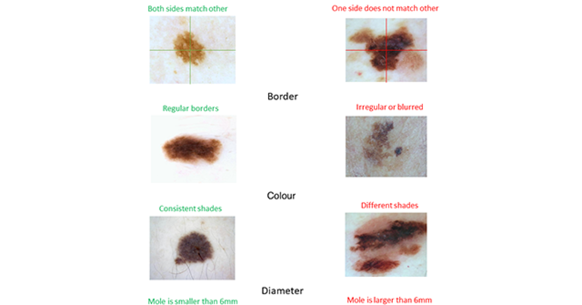 Clinical ABCD rule of melanoma image