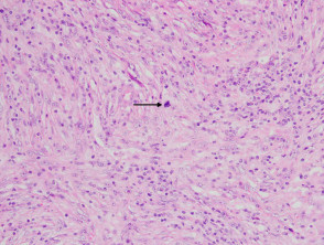 Inflammatory Myofibroblastic Tumour Pathology