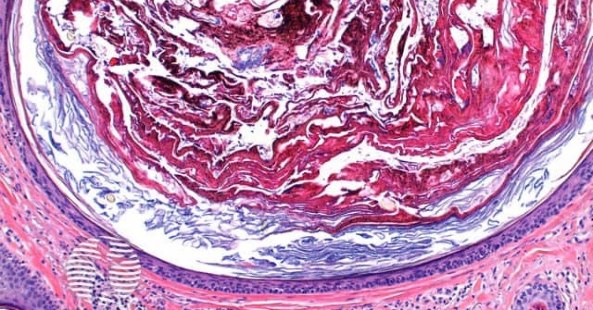 Favre Racouchot syndrome pathology image