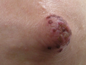 HSV of the nipple