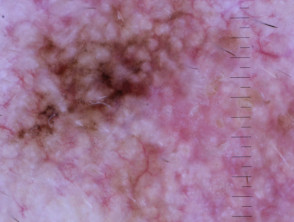 Lentigo maligna melanoma