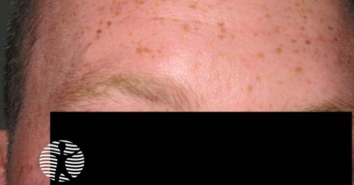 DermNet Fair Skin And Freckling Phenotype Image dermnet-fair-skin-and-freckling-phenotype-image