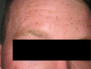 Fair skin and freckling phenotype