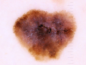 Invasive melanoma dermoscopy, Breslow 0.4mm within a melanoma in situ, with associated naevus present