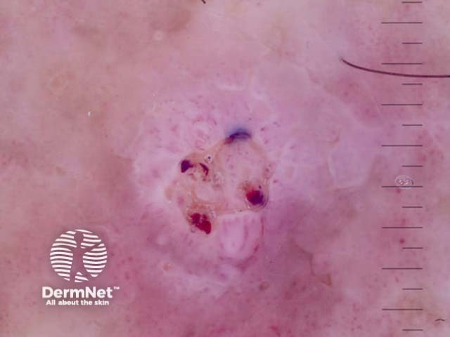 Invasive squamous cell carcinoma, keratoacanthoma type, nonpolarised dermoscopy view