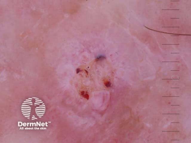 Invasive squamous cell carcinoma, keratoacanthoma type, polarised dermoscopy view
