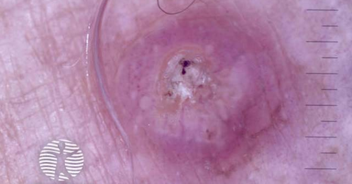 Dermnet® Invasive Squamous Cell Carcinoma Nonpolarised Dermoscopy View Image 5943