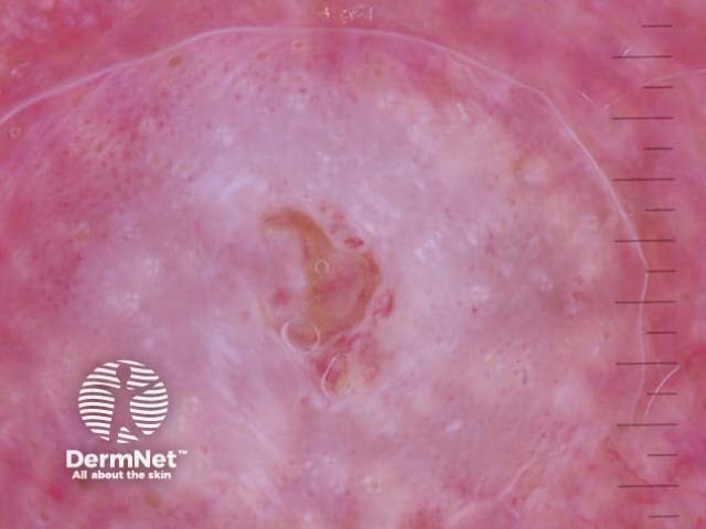 Invasive squamous cell carcinoma polarised dermoscopy view