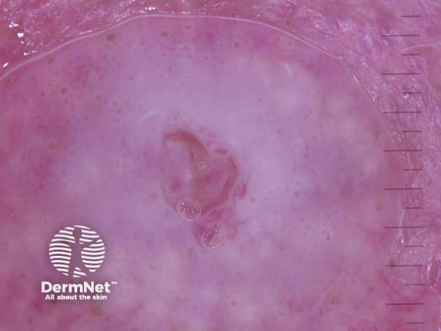 Invasive squamous cell carcinoma nonpolarised dermoscopy view