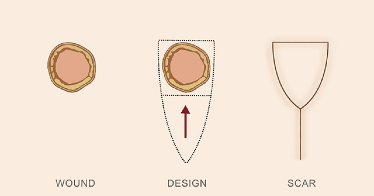 Pedicle Flaps Example Island Pedicle Flap3 image