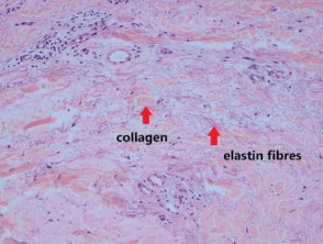 Histology of linear focal elastosis