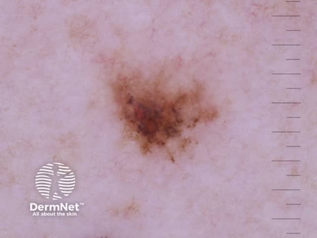 Angulated lines seen on dermoscopy of a small melanoma