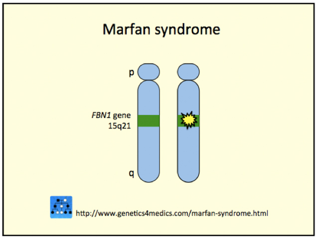 Genetics of Marfan syndrome*