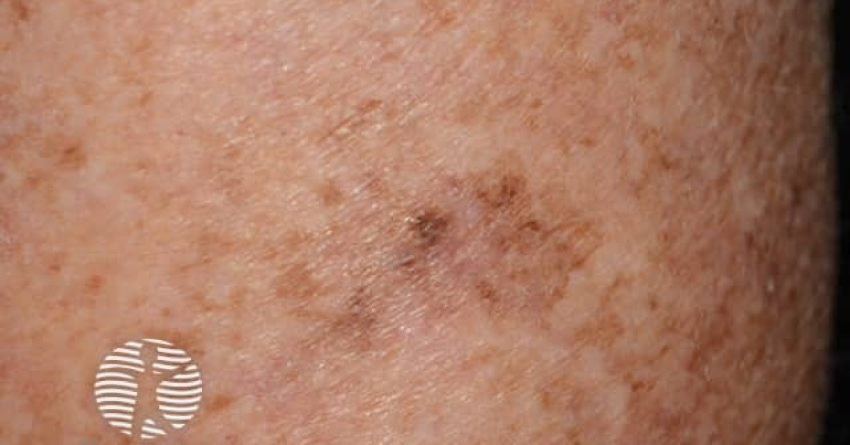 Melanoma in situ image