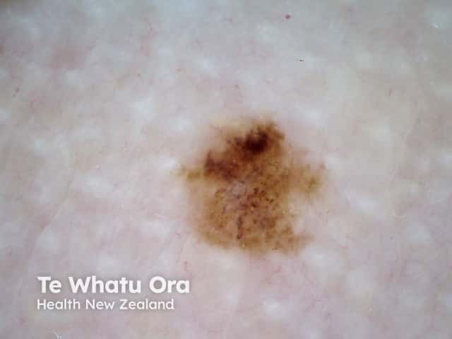 Dermoscopic image of melanoma in situ 13